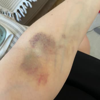 Hemşirelerin Yetersizliği Nedeniyle Kan Alımı Sırasında Yaşanan Sorun