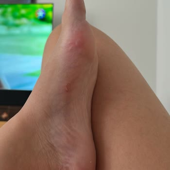 Derimod Sandalet Ayaklarımı Mahvetti Mağaza Çözüm Sunmuyor