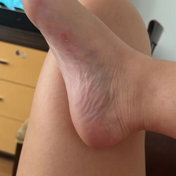 Derimod Sandalet Ayaklarımı Mahvetti Mağaza Çözüm Sunmuyor