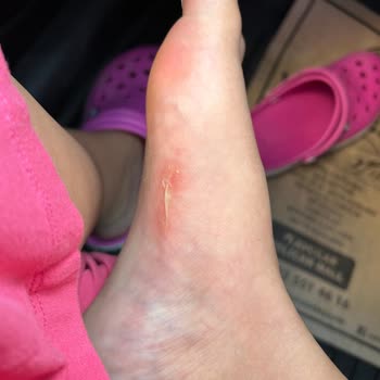 Derimod Sandalet Ayaklarımı Mahvetti Mağaza Çözüm Sunmuyor