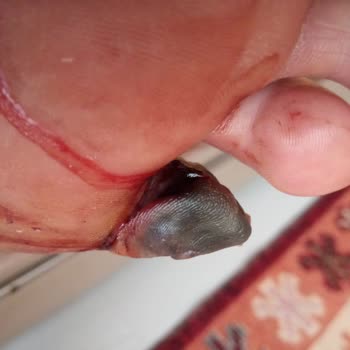 Diyabetik Ayakta Acil Müdahale Gecikmesi Babamın Parmağı Risk Altında