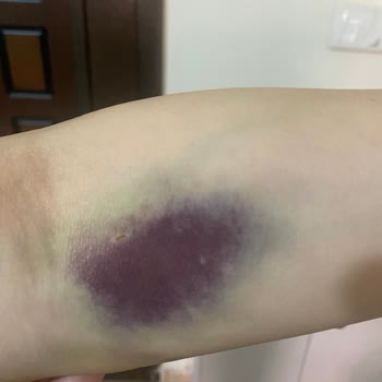 Liv Ankara Hastanesinde Kan Alımı Sonrası Morarma Ve İlgisizlik Mağduriyeti