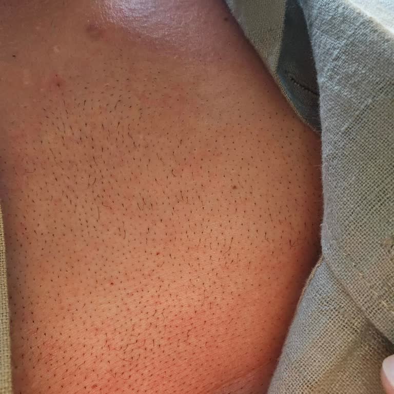 Agiss Tüy Dökücü Köpük Cildimde Şiddetli Yanma Ve Tahrişe Sebep Oldu