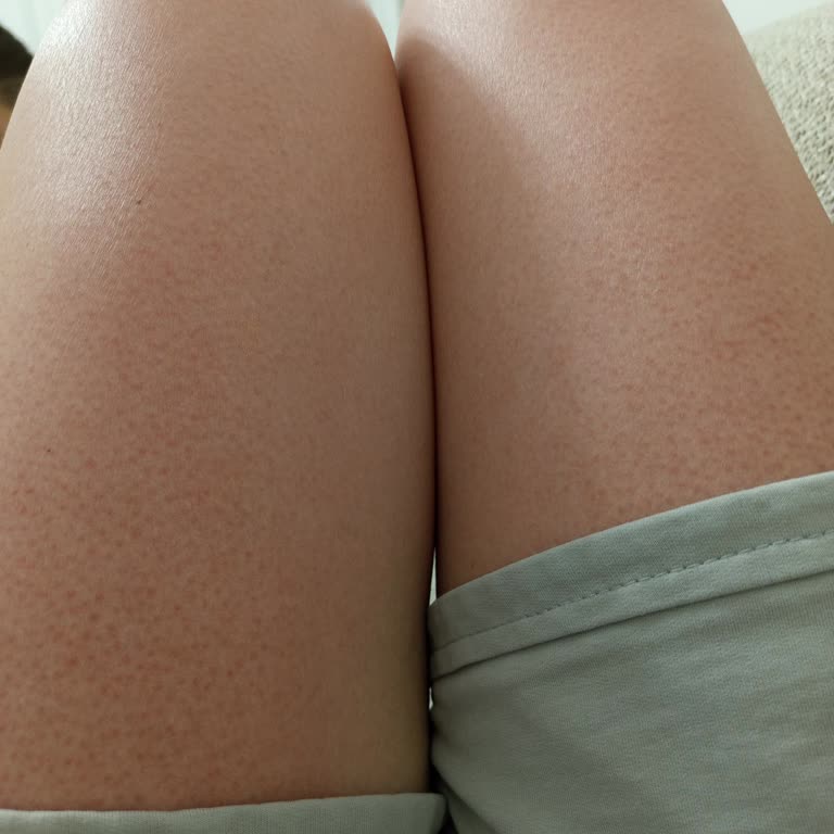 Bronzlaştırıcı Ürün Cildimde Alerji Ve Şişlik Yaptı