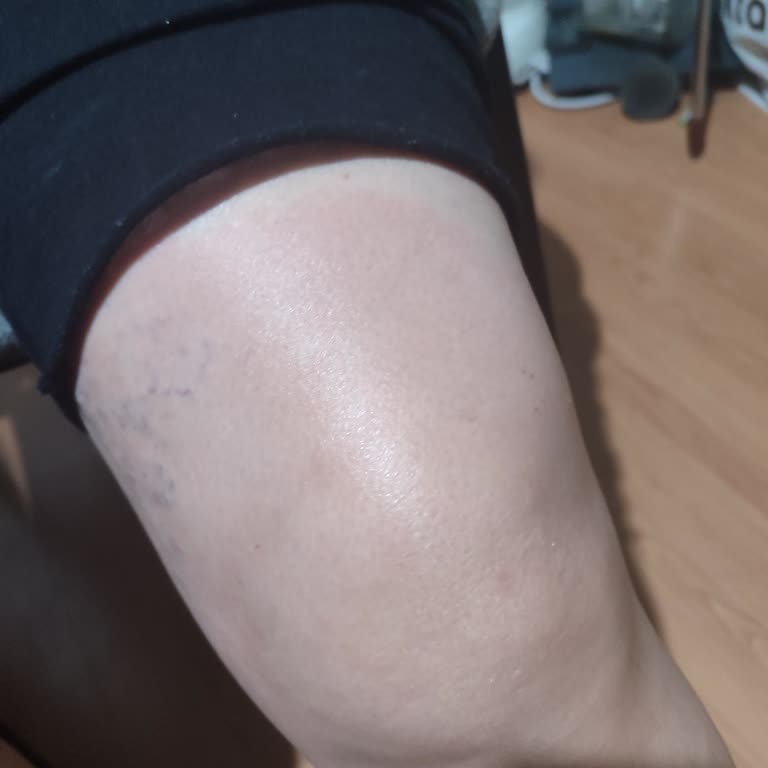 Thermoflex Krem Ciltte Yanma Ve Kızarıklık Yapıyor