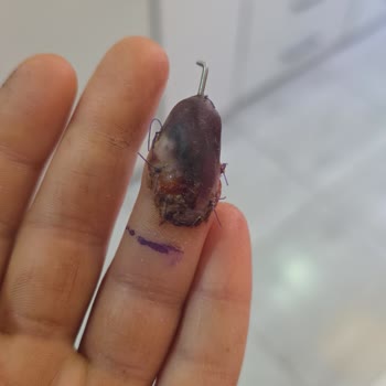 Ameliyat Sürecinde İlgisizlik Ve Yanıltıcı Bilgilendirme Nedeniyle Parmağımda Kalıcı Hasar Oluştu