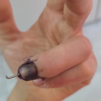 Ameliyat Sürecinde İlgisizlik Ve Yanıltıcı Bilgilendirme Nedeniyle Parmağımda Kalıcı Hasar Oluştu