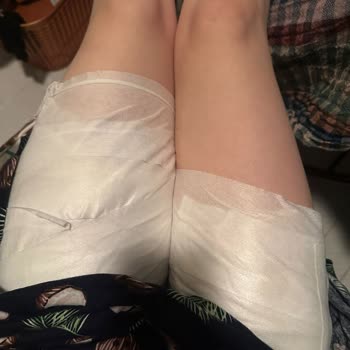 Sinbo Çaydanlık Kulpunun Kırılması Sonucu Yanık Yaşadım