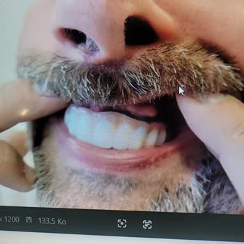 Dental Clinic Gave Me Faulty Full Dental Prostheses