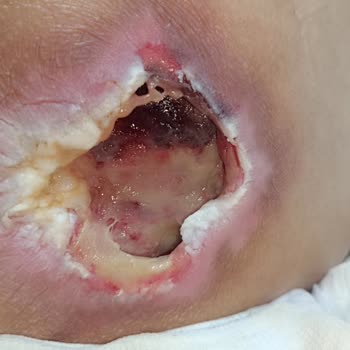 Yoğun Bakımda Yetersiz Hasta Bakımı Ve İlgisizlik