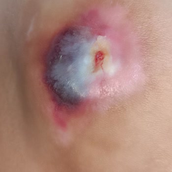 Yoğun Bakımda Yetersiz Hasta Bakımı Ve İlgisizlik