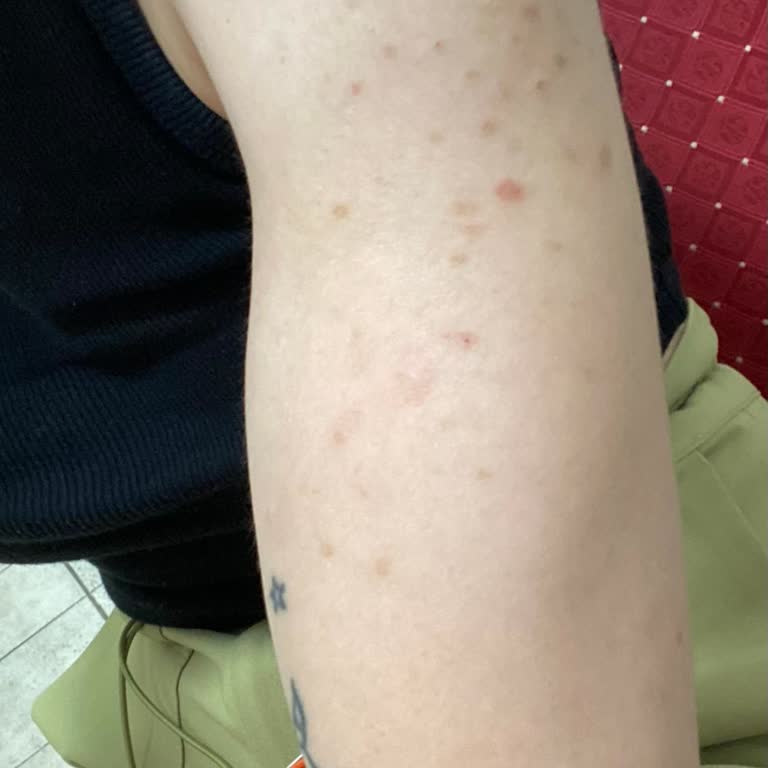 Suit Güzellik Merkezleri Lazer Epilasyon Sonrası Memnuniyetsizlik Ve Para İadesi Sorunu