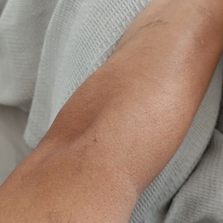 Eva Vip Güzellik Merkezi (Keşan) Lazer Epilasyon Sonrası Cilt Yanıkları Ve İlgisiz Hizmet