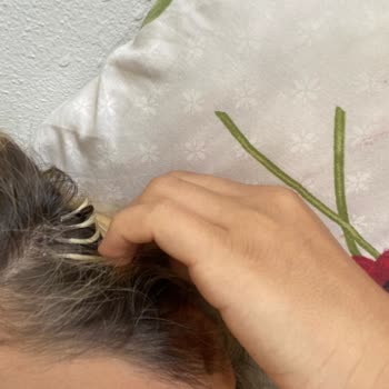 Kaynak Atölyesi (Mikrokaynak_bedirhan) Saç Kaynak İşlemi Sonrası Kötü Deneyim ve Saç Kaybı