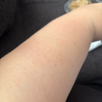 Nestle Nesfit Yulaflı Karışık Meyveli Paketten Böcek Çıkması Ve Sağlık Sorunu