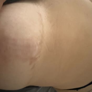 Estetik Operasyon Sonrası Beklentilerimin Karşılanmaması Ve Kalıcı İzler