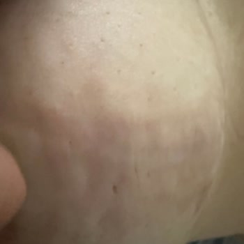 Estetik Operasyon Sonrası Beklentilerimin Karşılanmaması Ve Kalıcı İzler