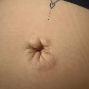 Estetik Operasyon Sonrası Beklentilerimin Karşılanmaması Ve Kalıcı İzler