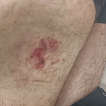 Sokak Köpekleri Saldırısı Sonrası Mağduriyetim Giderilmiyor