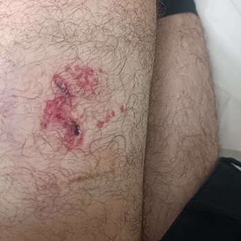 Sokak Köpekleri Saldırısı Sonrası Mağduriyetim Giderilmiyor