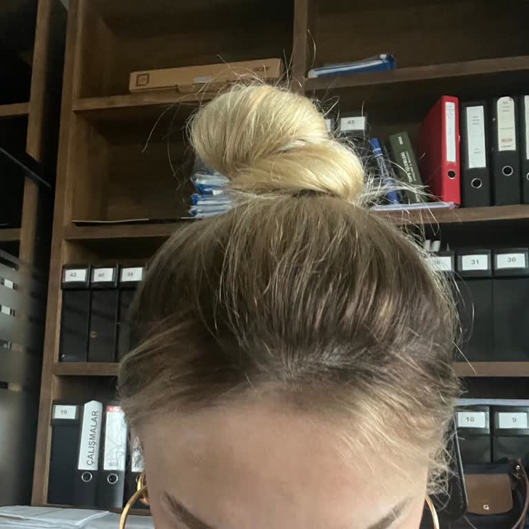 Saç Boyama İşlemi Sonrası Saçlarım Mahvoldu Kopmalar Ve Turunculuklar Oluştu