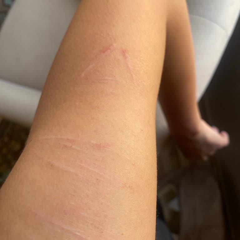 Fraksiyonel Lazer Tedavisinden Sonuç Alamadım Param İade Edilmedi