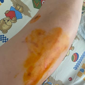 Yanlış Bilgilendirme Sonucu Ciltte Yanık Ve Su Toplaması