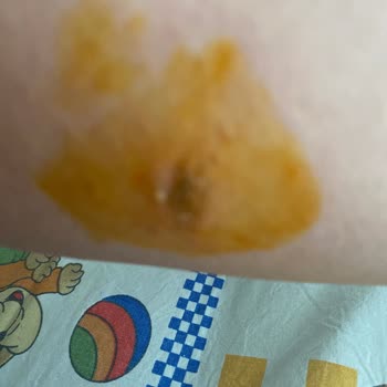 Yanlış Bilgilendirme Sonucu Ciltte Yanık Ve Su Toplaması