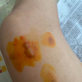 Yanlış Bilgilendirme Sonucu Ciltte Yanık Ve Su Toplaması