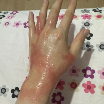 Krem Kullanımı Sonrası Ciltte Alerjik Reaksiyon Deneyimi