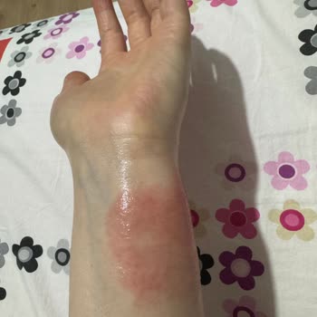 Krem Kullanımı Sonrası Ciltte Alerjik Reaksiyon Deneyimi