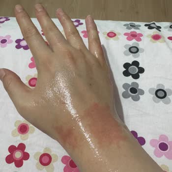 Krem Kullanımı Sonrası Ciltte Alerjik Reaksiyon Deneyimi