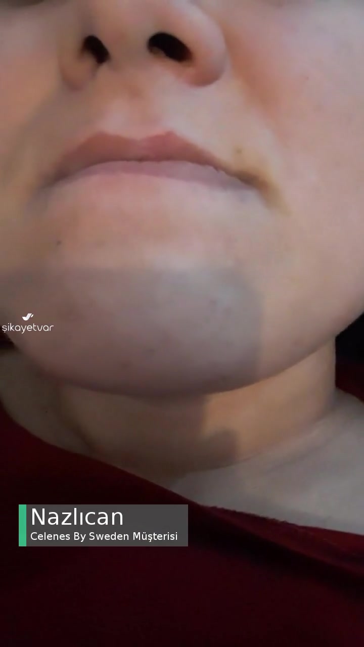 Celenes By Sweden Tonik Yüzde Pütürlenme Ve Kızarma Yaptı videonun kapak resmi