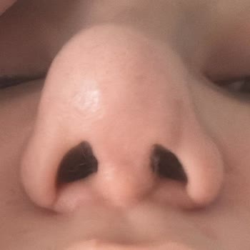 Op. Dr. Seyithan Kırtay Ameliyat Sonrası Sorunlarım Göz Ardı Edildi, Mağdurum