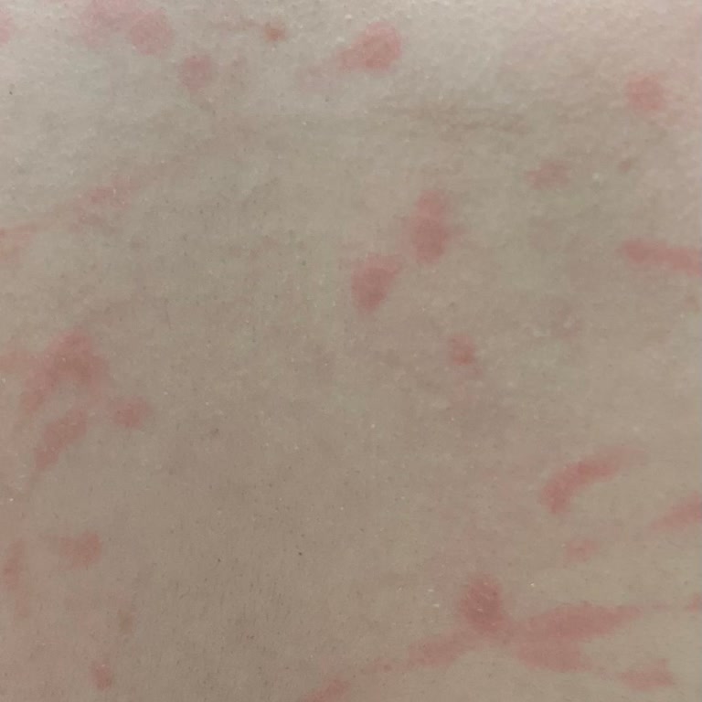 Lazer İşlem Sonrası Vücudumda Yanıklar Ve İlgisizlik Yaşadım