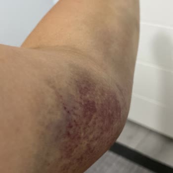 İlgisiz Sağlık Çalışanları Yüzünden Kolumda Ciddi Morluk Oluştu