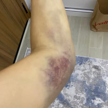 İlgisiz Sağlık Çalışanları Yüzünden Kolumda Ciddi Morluk Oluştu