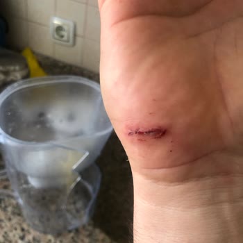 Sürahi Kapağı Oturmadı, Kırıldı Ve Elim Kesildi