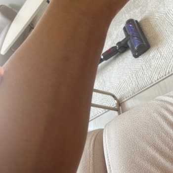 Tüy Sarartıcı Sonrası Bacaklarımda Morluklar Oluştu