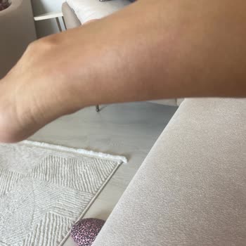 Tüy Sarartıcı Sonrası Bacaklarımda Morluklar Oluştu