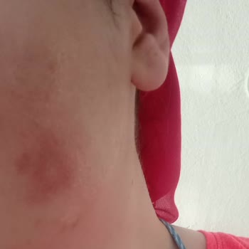 Dalin Bebek Şampuanı Yüzümde Kalıcı Hasar Ve Alerjiye Yol Açtı