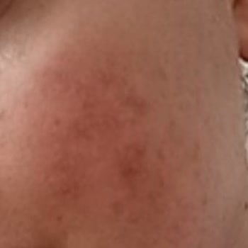 Dalin Bebek Şampuanı Yüzümde Kalıcı Hasar Ve Alerjiye Yol Açtı