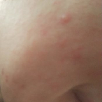 Dalin Bebek Şampuanı Yüzümde Kalıcı Hasar Ve Alerjiye Yol Açtı