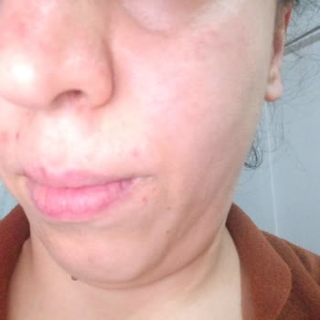 Ciltte Yanıklara Sebep Olan Güneş Kremi İçin Acil İnceleme Ve Mağduriyet Giderimi Talebi