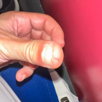 Trende Yaralanma Sonrası Yetersiz Müdahale Ve İlgisizlik