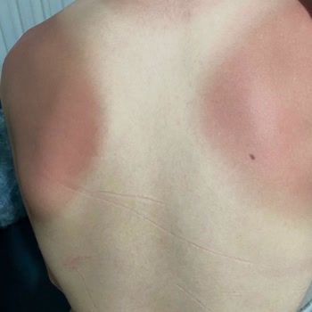 Maruderm Güneş Kremi Kullanımı Sonrası Yaşanan Cilt Yanıkları