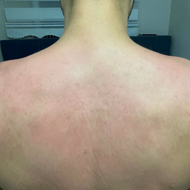 Gratis Maruderm Güneş Kremi Cildimizi Yaktı, Mağduriyetimizin Giderilmesini İstiyoruz