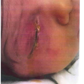 Hastanede Torunumun Enfeksiyon Kapması Ve İlgisiz Personel Şikayeti