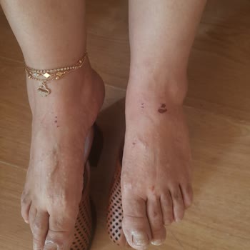 Ayak Yaralanmasına Sebep Olan Ayakkabının İadesinin Gerekçesiz Reddedilmesi