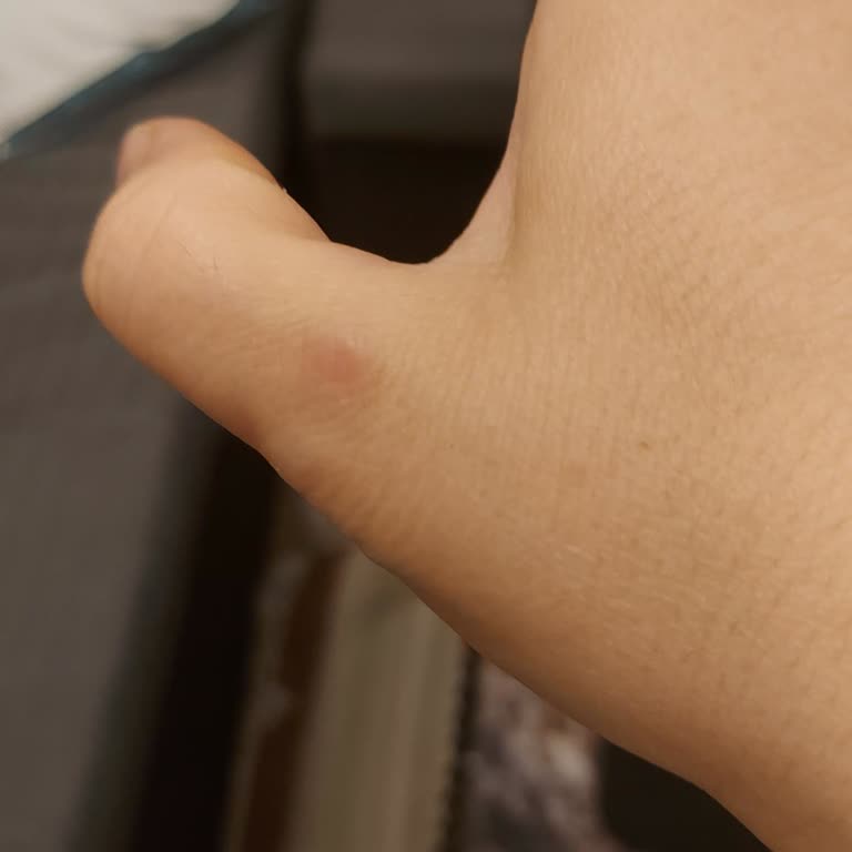 I Burn My Thumb Using Dyson V15 Submarine—Motor Area Overheats and Hurts to Touch